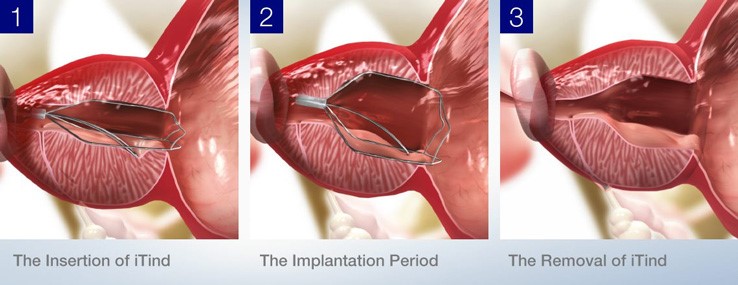 iTind Procedure