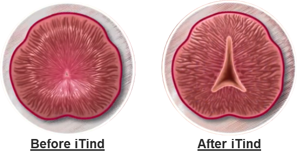 iTind Procedure Steps