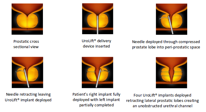 UroLift system for minimally invasive BPH treatment